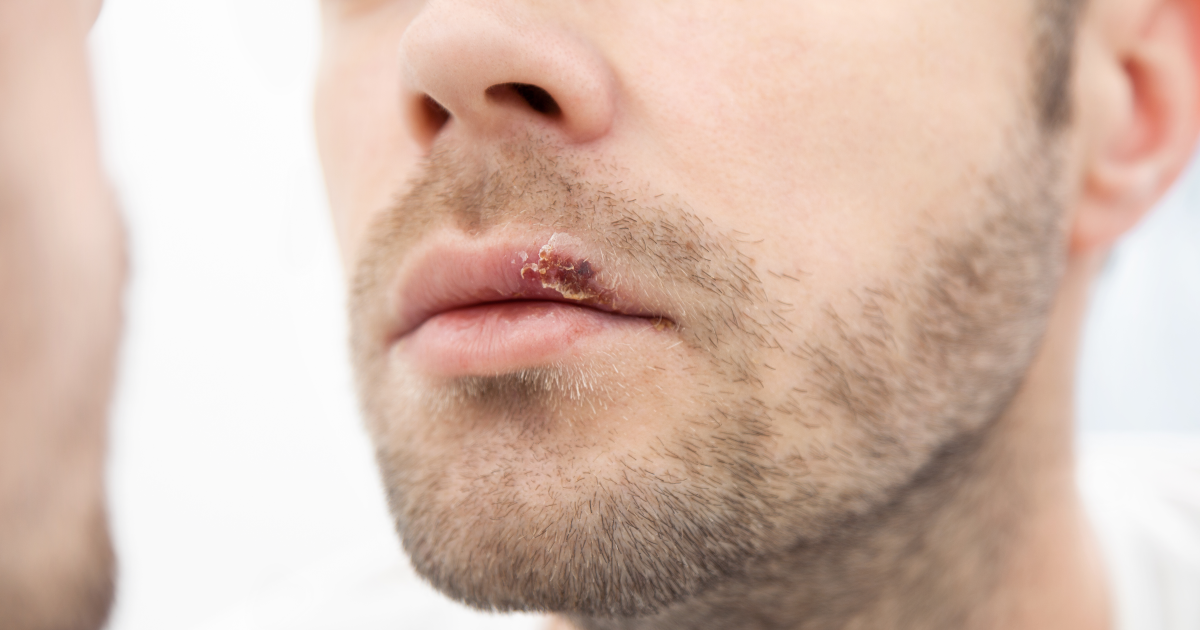 Die besten Hausmittel gegen Lippenherpes | Naturhaus Magazin