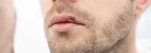 Hausmittel gegen Lippenherpes