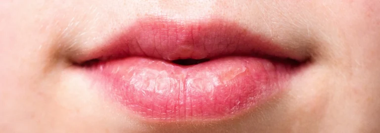Was sind Aphten und wie entstehen sie?